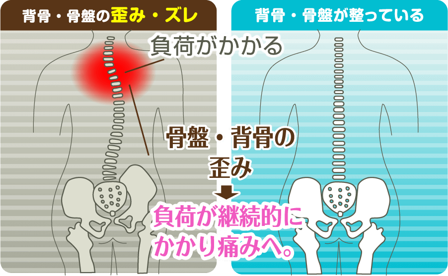 正常な骨盤と歪んでいる骨盤の図